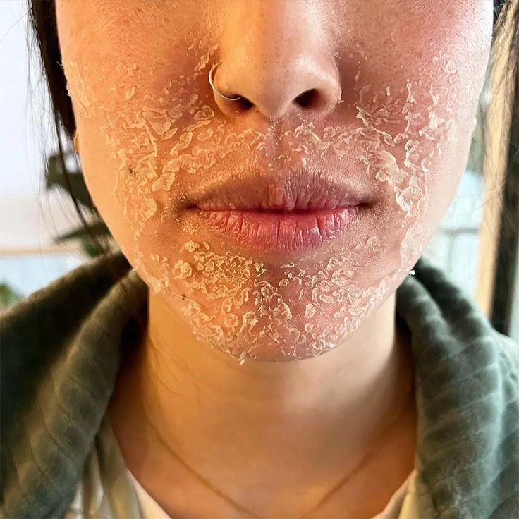 Chemical-Peeling