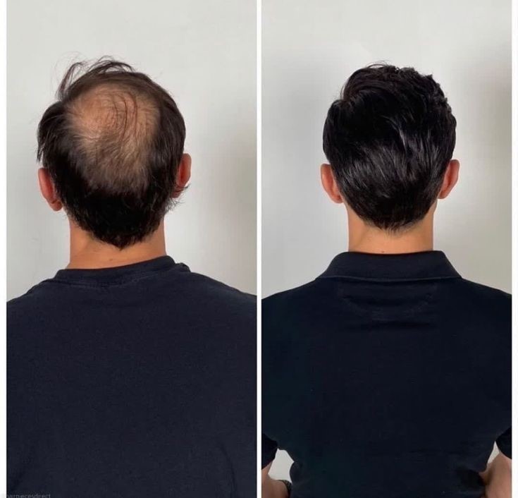 Hair-loss